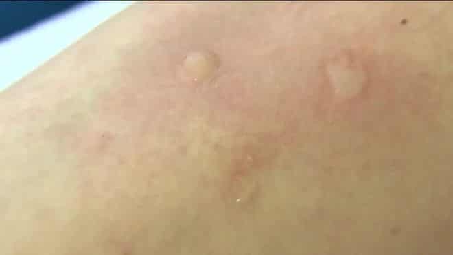 Аллергия на мандарины у ребенка лечение thumbnail