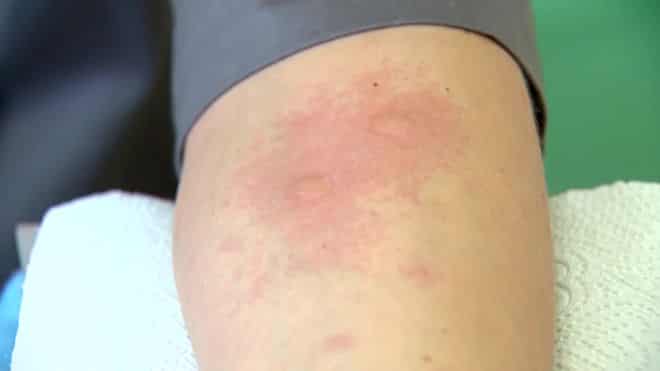 Фото на аллергию от мандаринов thumbnail